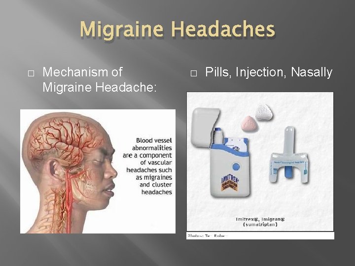 Migraine Headaches � Mechanism of Migraine Headache: � Pills, Injection, Nasally 