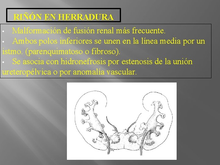 RIÑÓN EN HERRADURA Malformación de fusión renal más frecuente. • Ambos polos inferiores se