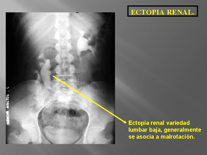 ECTOPIA RENAL. Ectopia renal variedad lumbar baja, generalmente se asocia a malrotación. 
