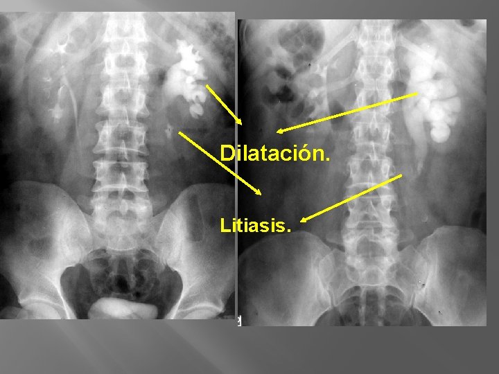 Dilatación. Litiasis. 