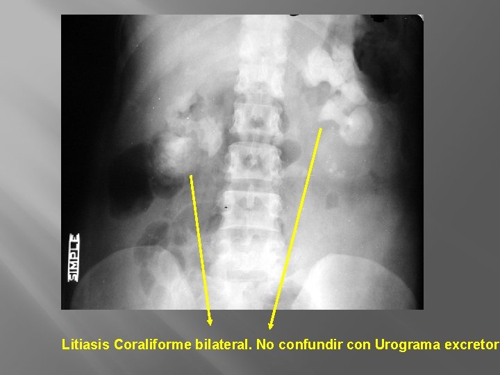 Litiasis Coraliforme bilateral. No confundir con Urograma excretor. 