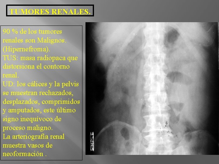 TUMORES RENALES. 90 % de los tumores renales son Malignos. (Hipernefroma). TUS: masa radiopaca