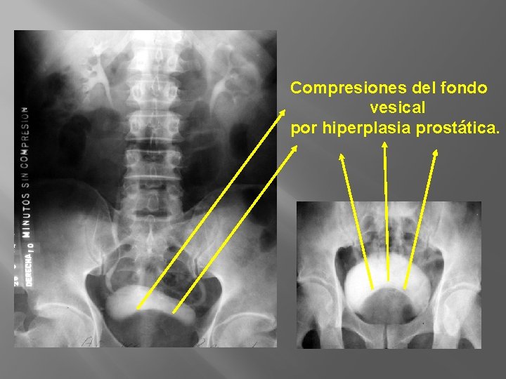 Compresiones del fondo vesical por hiperplasia prostática. 
