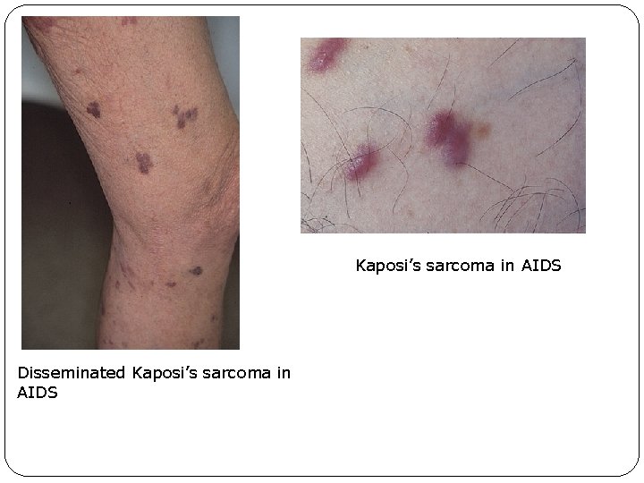 Kaposi’s sarcoma in AIDS Disseminated Kaposi’s sarcoma in AIDS 