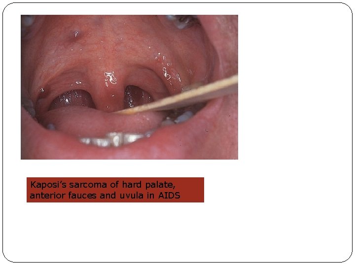 Kaposi’s sarcoma of hard palate, anterior fauces and uvula in AIDS 
