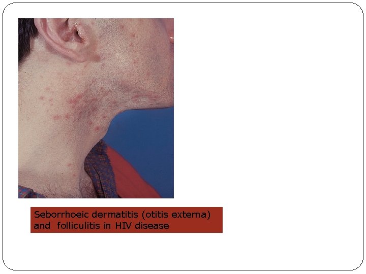 Seborrhoeic dermatitis (otitis externa) and folliculitis in HIV disease 