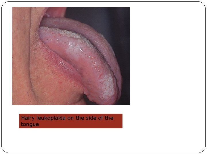 Hairy leukoplakia on the side of the tongue 