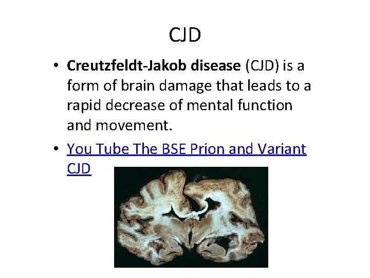 CJD • Creutzfeldt-Jakob disease (CJD) is a form of brain damage that leads to