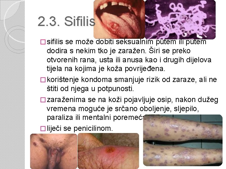 2. 3. Sifilis � sifilis se može dobiti seksualnim putem ili putem dodira s