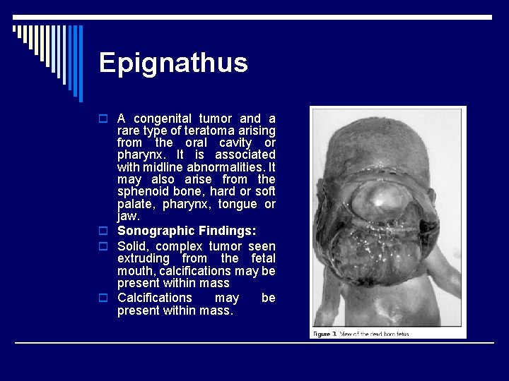Epignathus o A congenital tumor and a rare type of teratoma arising from the