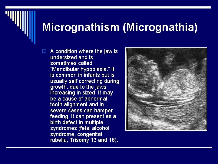 Micrognathism (Micrognathia) o A condition where the jaw is undersized and is sometimes called