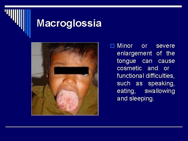 Macroglossia o Minor or severe enlargement of the tongue can cause cosmetic and or