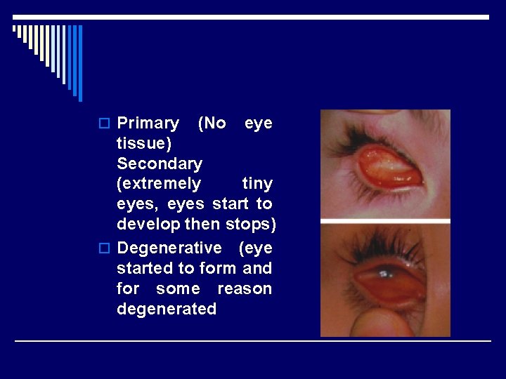 o Primary (No eye tissue) Secondary (extremely tiny eyes, eyes start to develop then