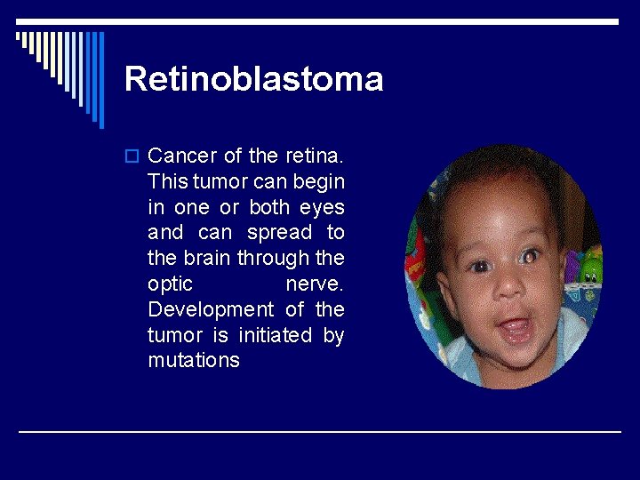 Retinoblastoma o Cancer of the retina. This tumor can begin in one or both