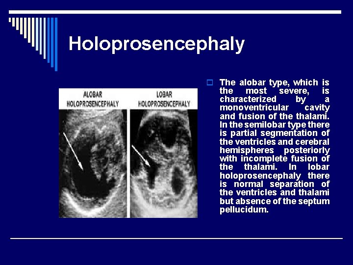 Holoprosencephaly o The alobar type, which is the most severe, is characterized by a