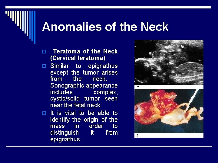 Anomalies of the Neck Teratoma of the Neck (Cervical teratoma) o Similar to epignathus