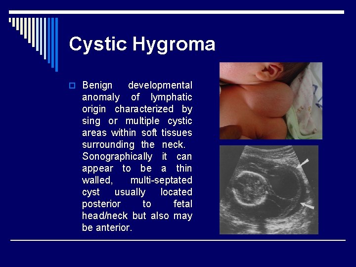 Cystic Hygroma o Benign developmental anomaly of lymphatic origin characterized by sing or multiple