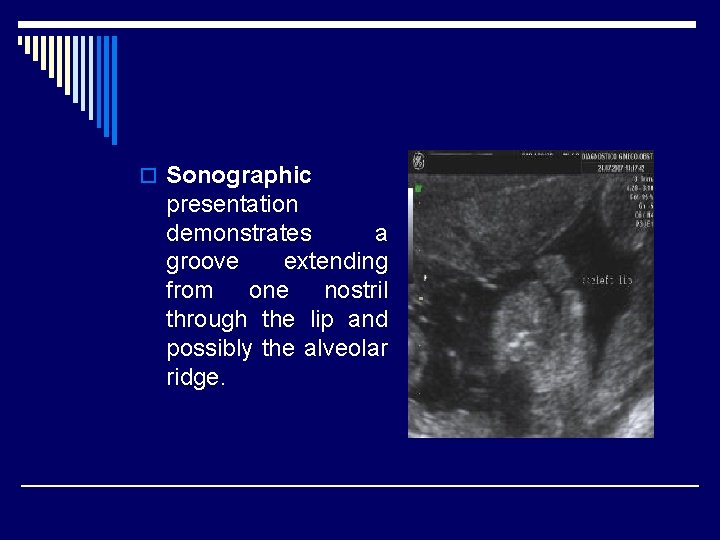 o Sonographic presentation demonstrates a groove extending from one nostril through the lip and