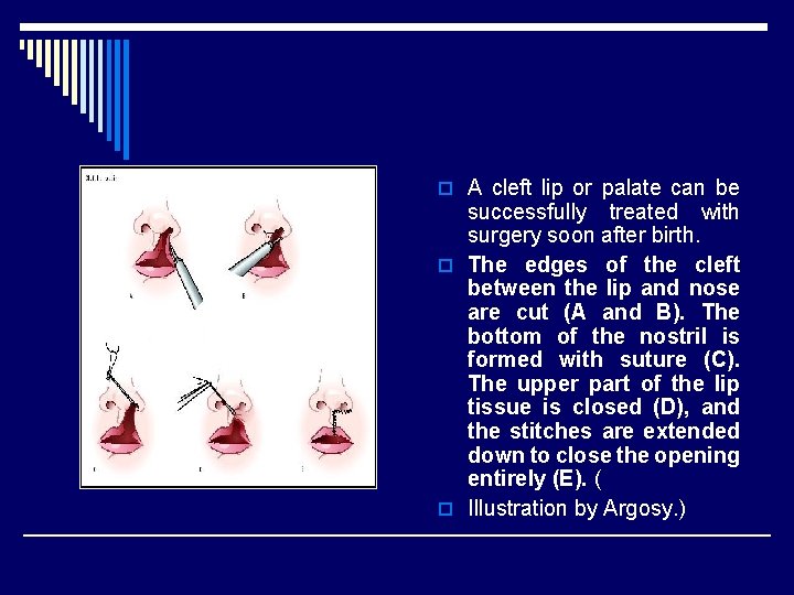 o A cleft lip or palate can be successfully treated with surgery soon after