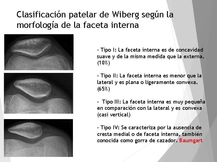 Clasificación patelar de Wiberg según la morfología de la faceta interna - Tipo I: