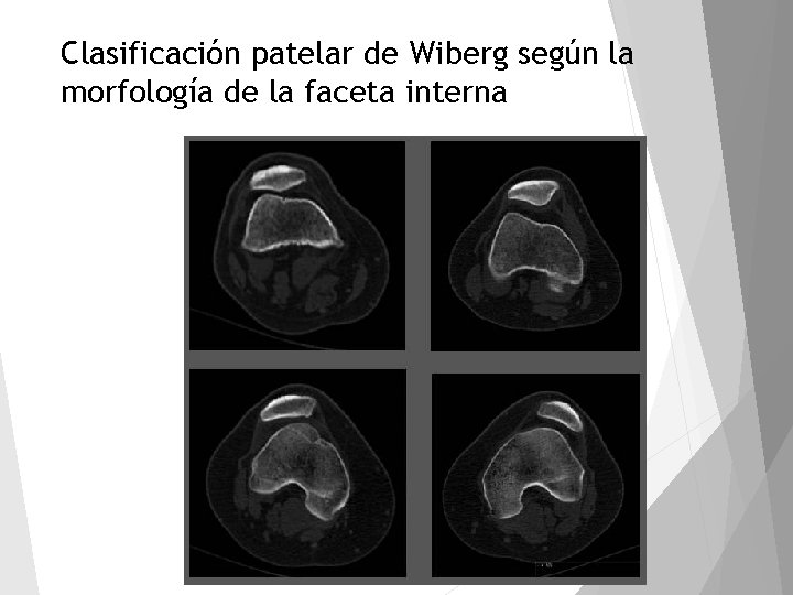 Clasificación patelar de Wiberg según la morfología de la faceta interna 