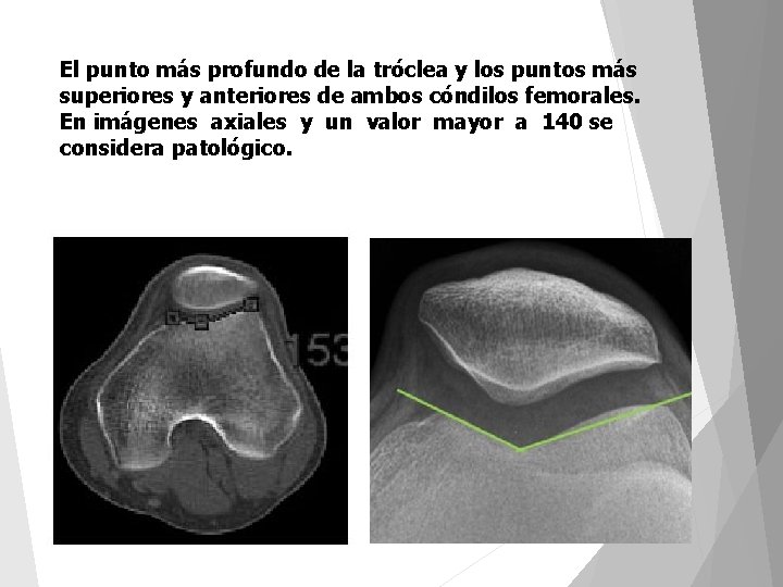 El punto más profundo de la tróclea y los puntos más superiores y anteriores