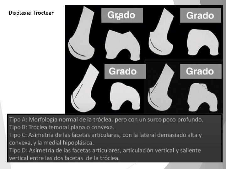 Displasia Troclear A C B C 