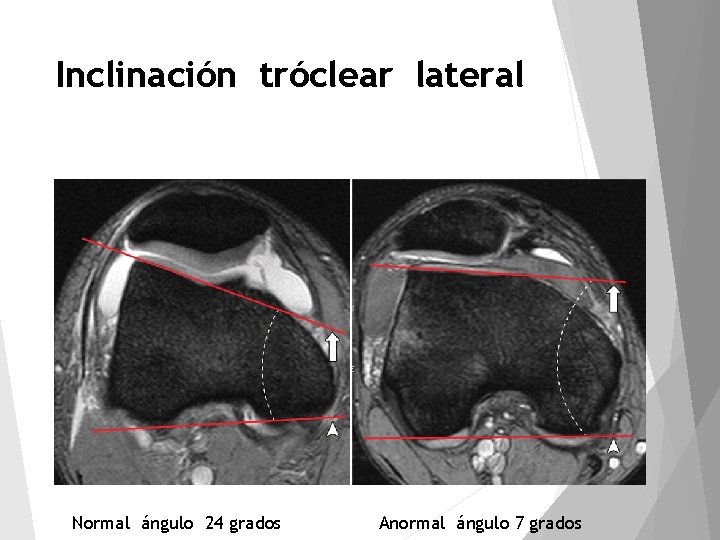 Inclinación tróclear lateral Normal ángulo 24 grados Anormal ángulo 7 grados 