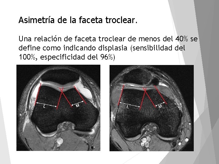 Asimetría de la faceta troclear. Una relación de faceta troclear de menos del 40%