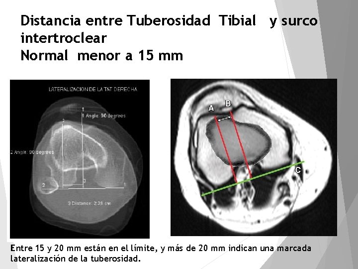 Distancia entre Tuberosidad Tibial y surco intertroclear Normal menor a 15 mm Entre 15