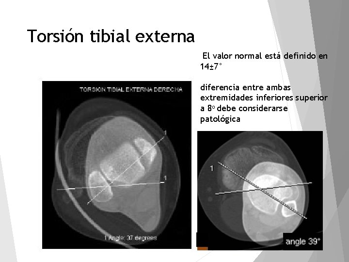 Torsión tibial externa El valor normal está definido en 14± 7° diferencia entre ambas