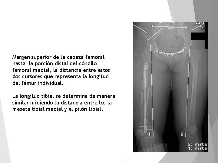 Margen superior de la cabeza femoral hasta la porción distal del cóndilo femoral medial,