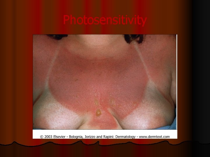 Photosensitivity 