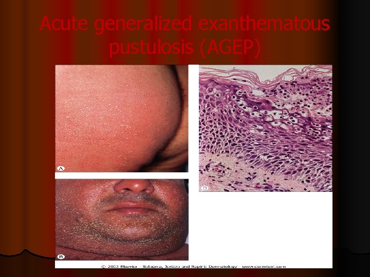 Acute generalized exanthematous pustulosis (AGEP) 