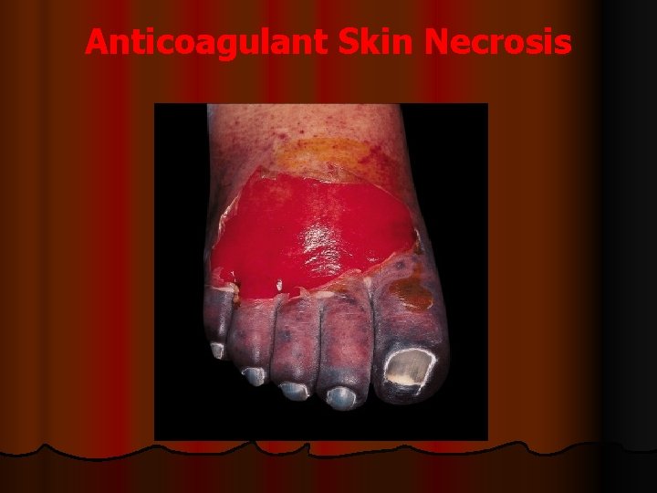 Anticoagulant Skin Necrosis 