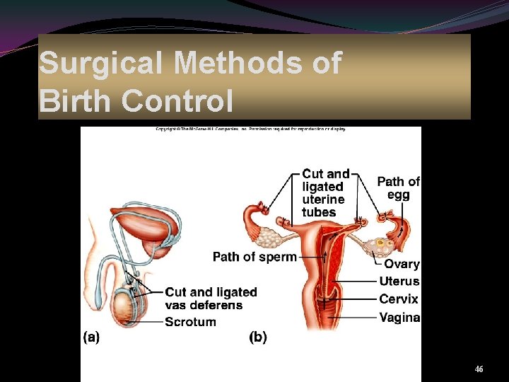 Surgical Methods of Birth Control Vasectomy Tubal ligation 46 