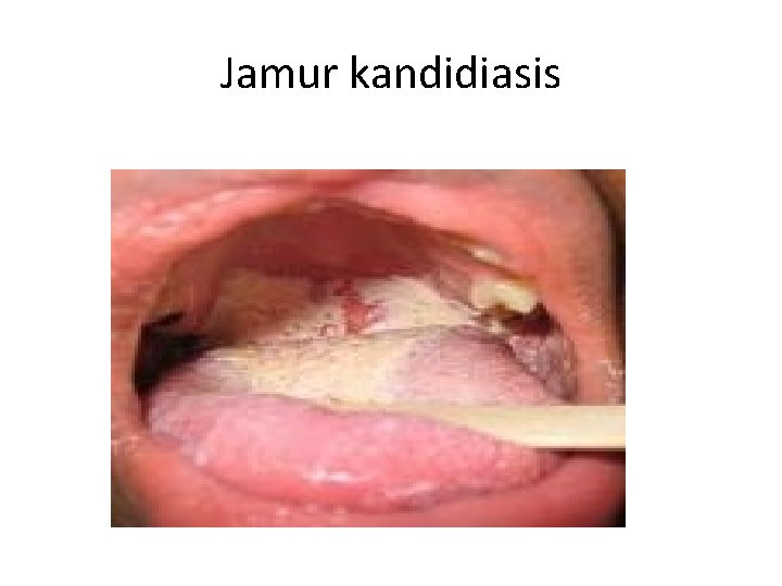 Jamur kandidiasis 