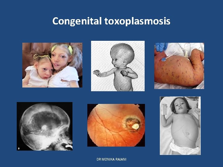 Congenital toxoplasmosis DR MONIKA RAJANI 