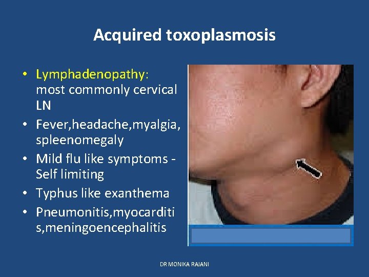 Acquired toxoplasmosis • Lymphadenopathy: most commonly cervical LN • Fever, headache, myalgia, spleenomegaly •