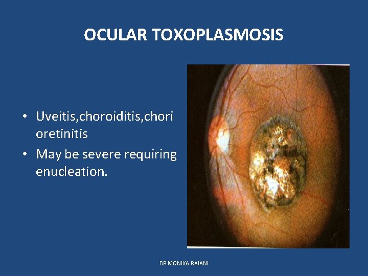 OCULAR TOXOPLASMOSIS • Uveitis, choroiditis, chori oretinitis • May be severe requiring enucleation. DR