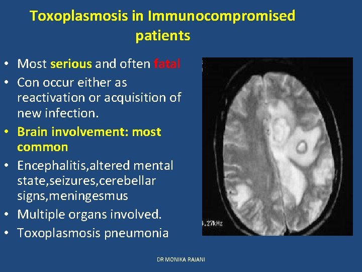 Toxoplasmosis in Immunocompromised patients • Most serious and often fatal • Con occur either