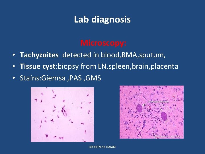 Lab diagnosis Microscopy: • Tachyzoites detected in blood, BMA, sputum, • Tissue cyst: biopsy