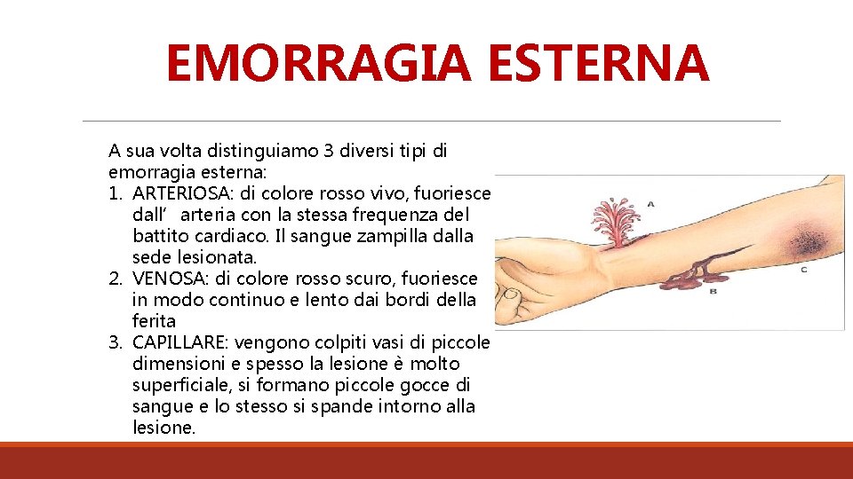 EMORRAGIA ESTERNA A sua volta distinguiamo 3 diversi tipi di emorragia esterna: 1. ARTERIOSA: