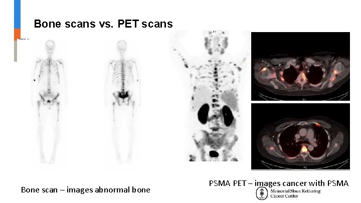 Bone scans vs. PET scans Bone scan – images abnormal bone PSMA PET – Bone scans vs. PET scans Bone scan – images abnormal bone PSMA PET –