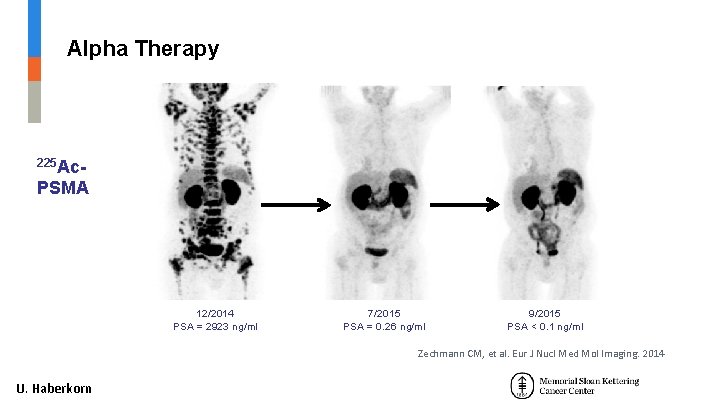 Alpha Therapy 225 Ac- PSMA 12/2014 PSA = 2923 ng/ml 7/2015 PSA = 0. Alpha Therapy 225 Ac- PSMA 12/2014 PSA = 2923 ng/ml 7/2015 PSA = 0.