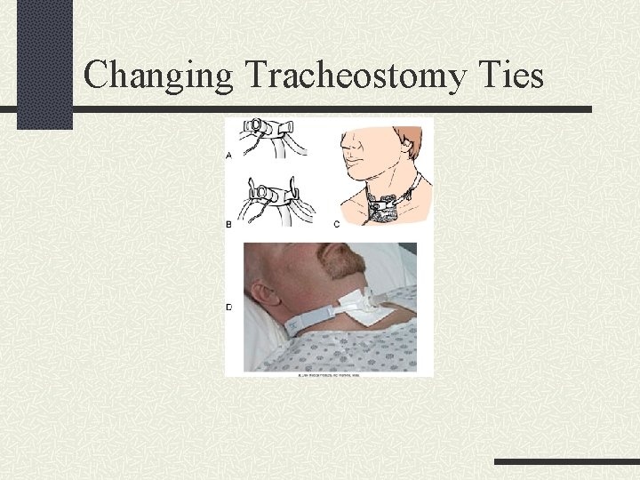Changing Tracheostomy Ties 