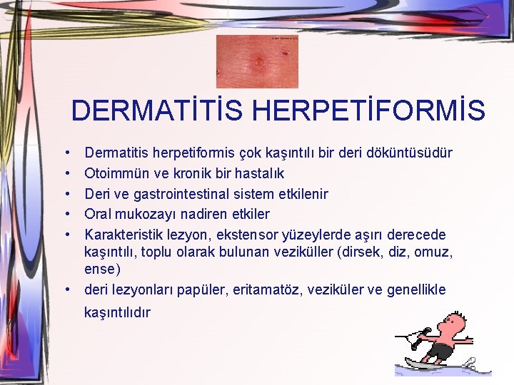 DERMATİTİS HERPETİFORMİS • • • Dermatitis herpetiformis çok kaşıntılı bir deri döküntüsüdür Otoimmün ve