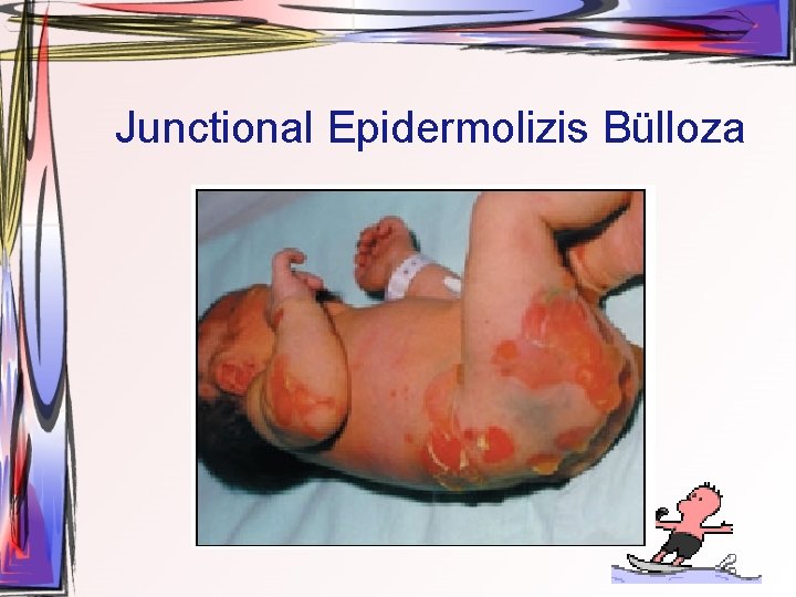 Junctional Epidermolizis Bülloza 