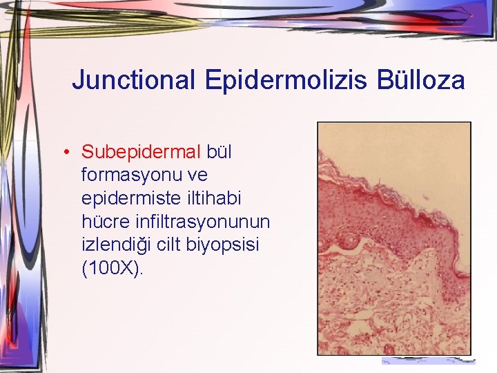 Junctional Epidermolizis Bülloza • Subepidermal bül formasyonu ve epidermiste iltihabi hücre infiltrasyonunun izlendiği cilt