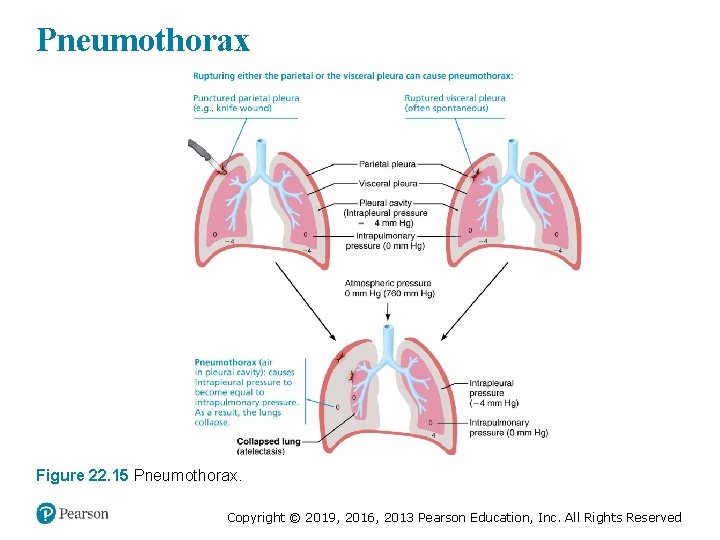 Pneumothorax Figure 22. 15 Pneumothorax. Copyright © 2019, 2016, 2013 Pearson Education, Inc. All